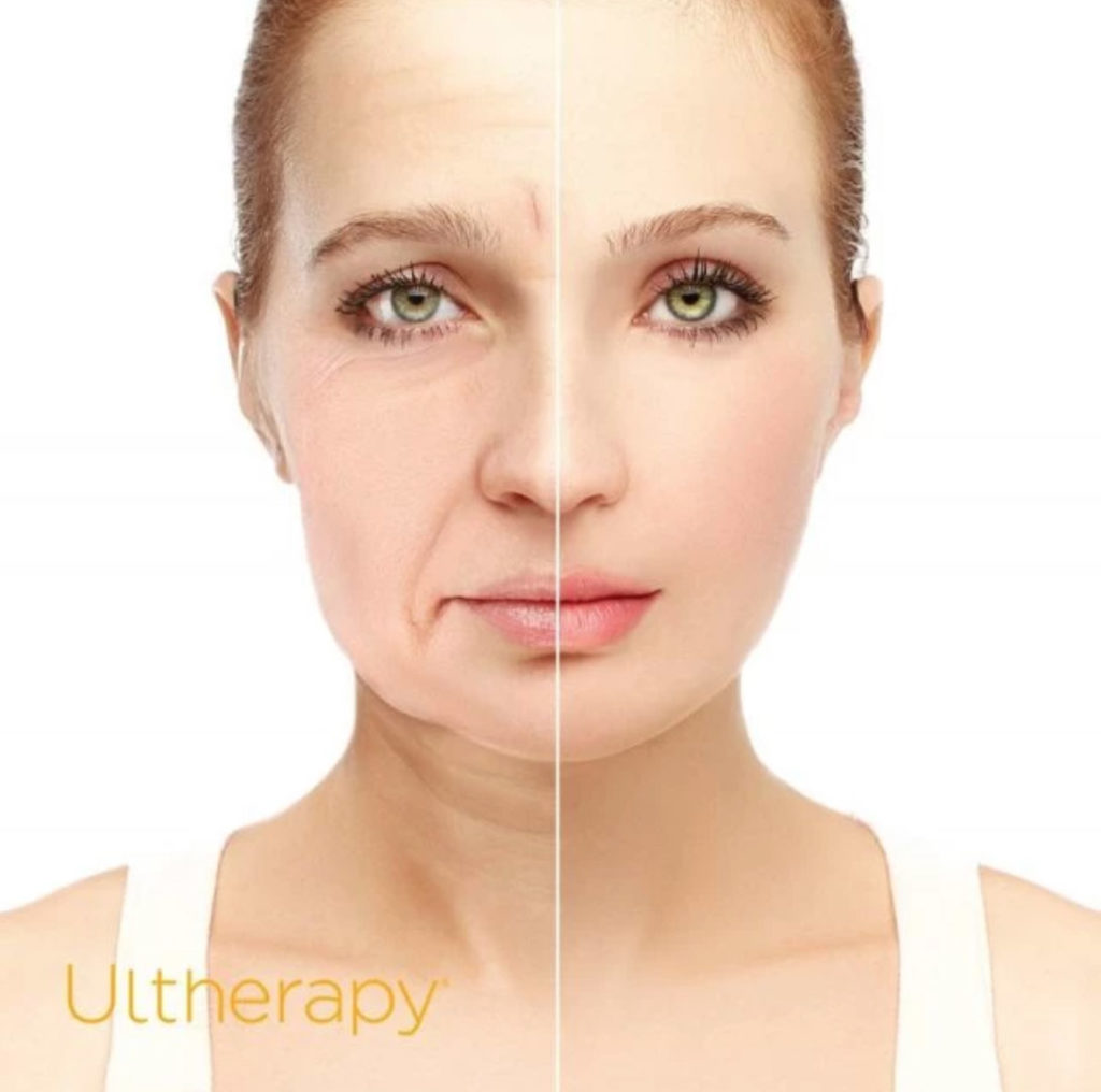 Ultherapy Hifu - 提拉療程