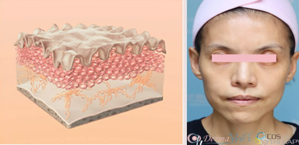 Derma Veil 童顏針 11