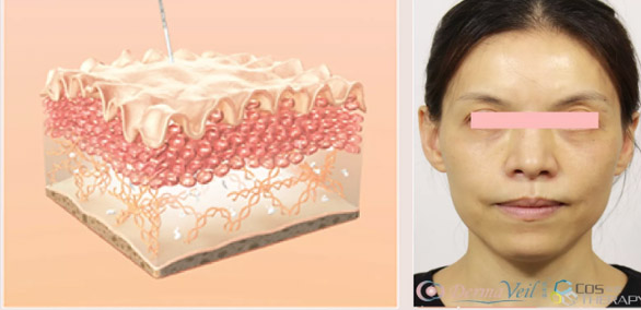 Derma Veil 12 - ​輪廓療程