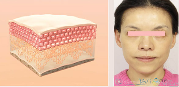 Derma Veil 童顏針 13