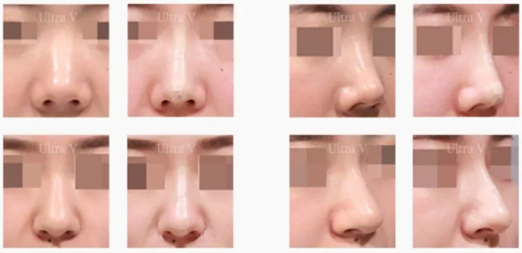 Pcl 4 1024x497 - 「真、鼻、特」療程 - ​輪廓療程