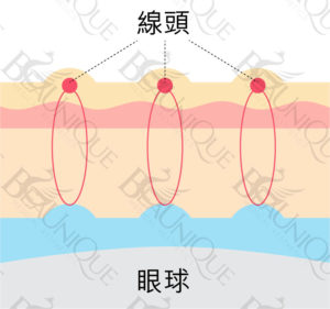 -08-300x281 - 哈佛定點雙眼皮​ - 眼部療程