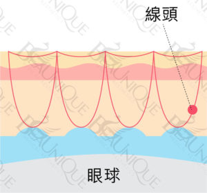 -13-300x281 - 哈佛定點雙眼皮​ - 眼部療程