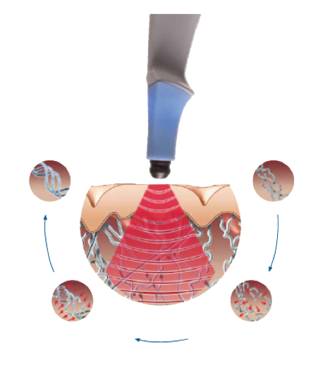 Exilis Ultra 360°女神彈彈 4