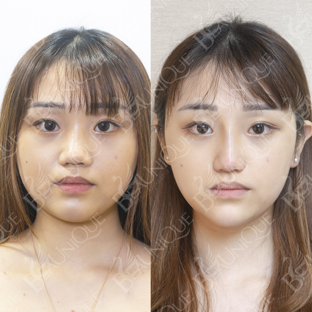 No1瘦面專家 4