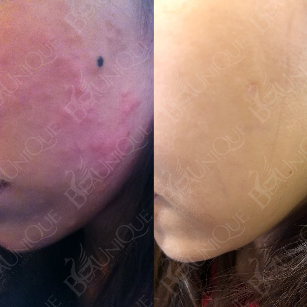 Before After 2