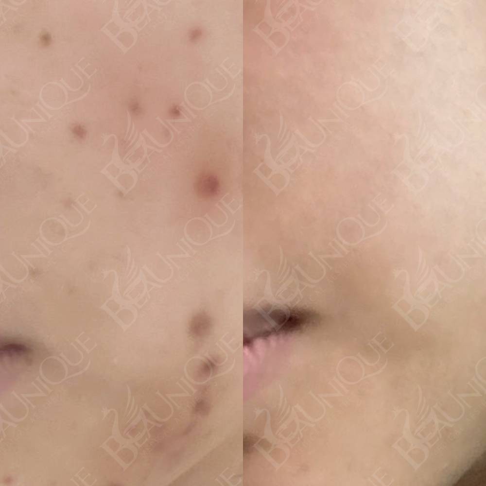 Before After 3