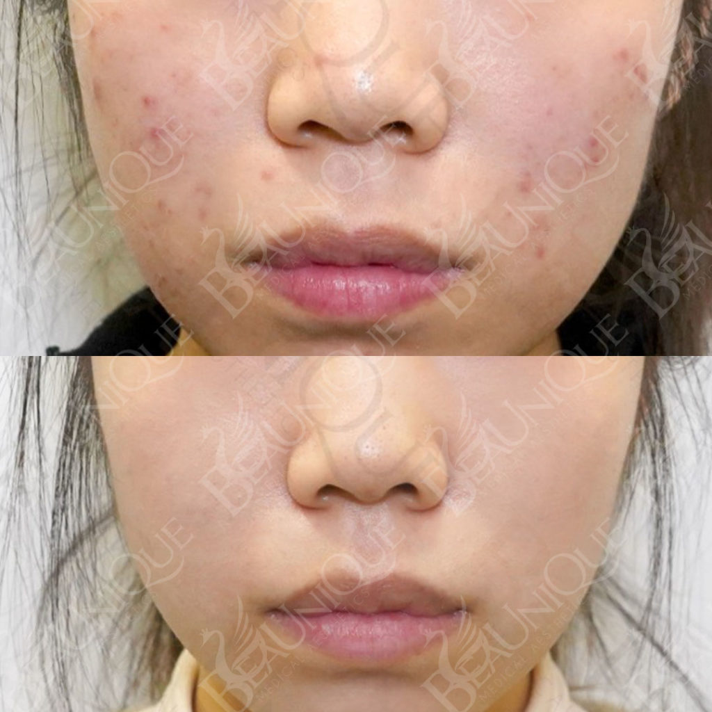 Before After 6
