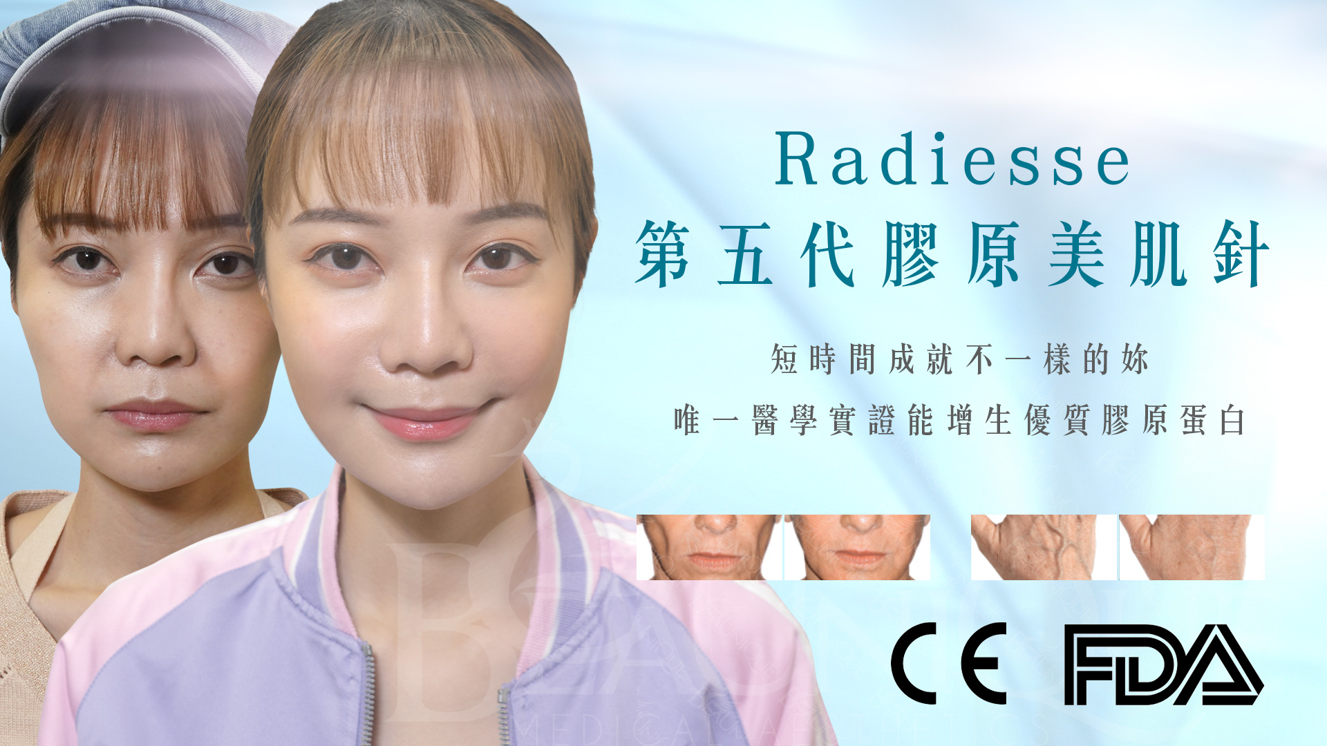 Radiesse 3 - ​輪廓療程