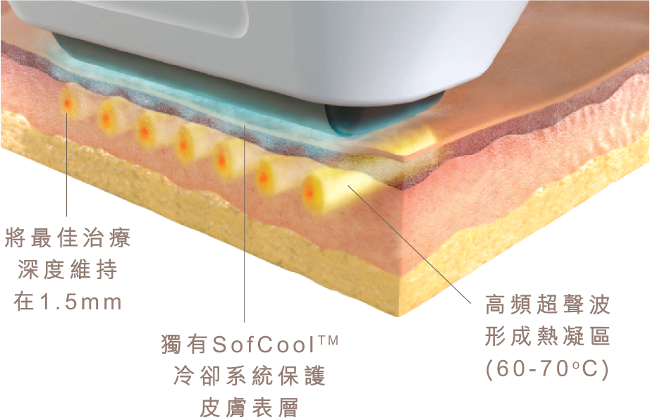 Sofwave Info 3 - 提拉療程