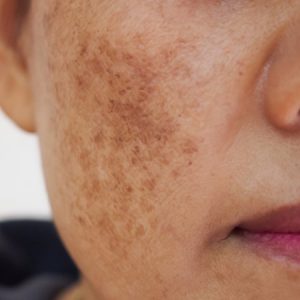 Melasma 2
